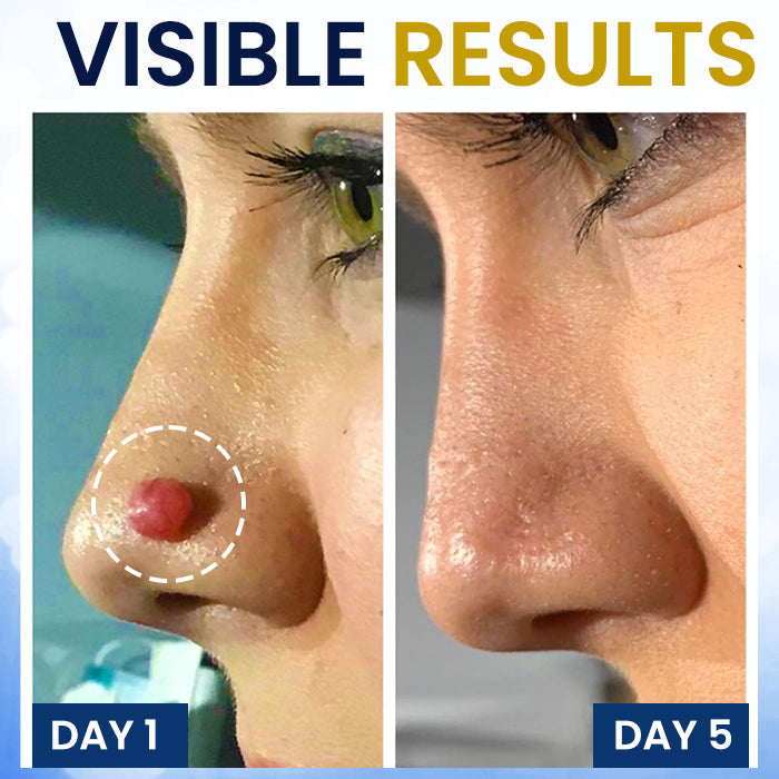 AEXZR® cryotherapy Spray: Quick removal of warts and corneas - results visible in 7 days ✨