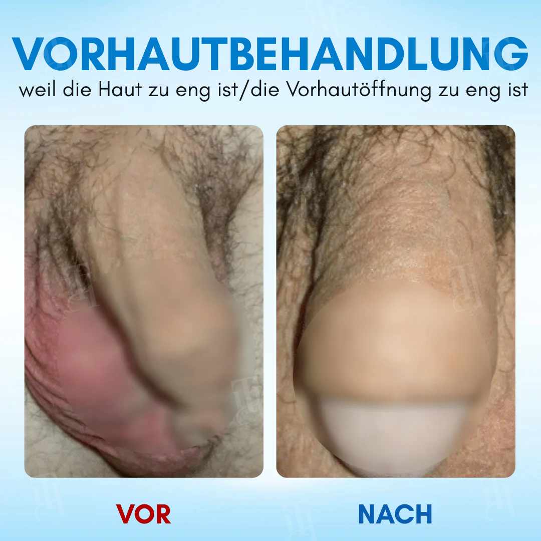 Nur für kurze Zeit! ⚡ RZXEA™ Vorhaut-Elastizitätsgel: Holen Sie sich Ihren Vorsprung zurück, starten Sie Ihre Vitalität neu.