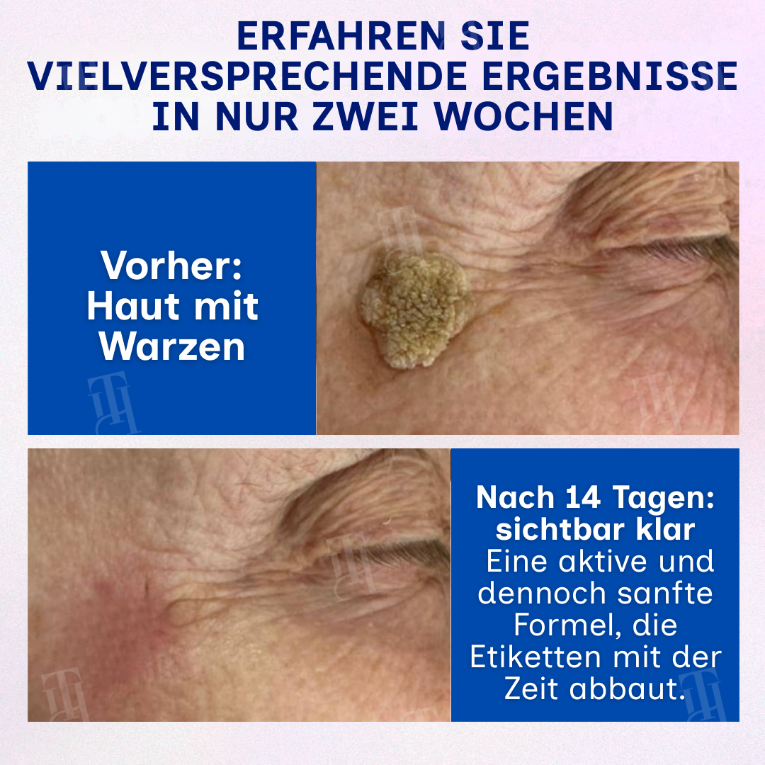🌟 Offizieller Store | 🛡️ Das “Klebestift“-Geheimnis für reine Haut! RZXEA™ | Solid-Stick-Warzenentferner, Hautanhängsel in nur 48 Stunden!