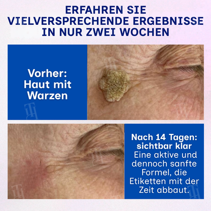 🌟 Offizieller Store | 🛡️ Das “Klebestift“-Geheimnis für reine Haut! RZXEA™ | Solid-Stick-Warzenentferner, Hautanhängsel in nur 48 Stunden!