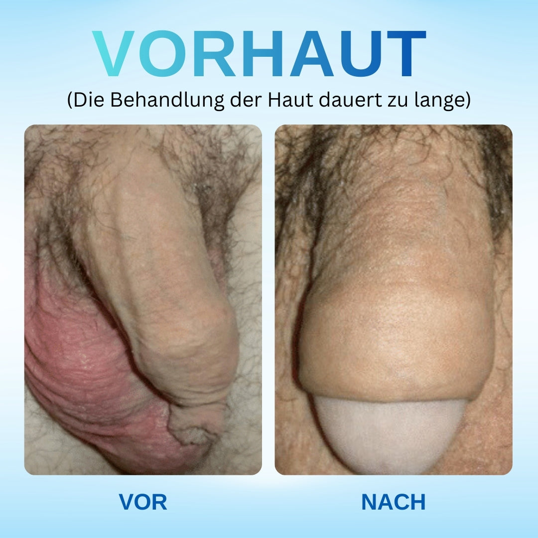 ⚡ Sichtbare Ergebnisse in nur 24 Stunden: RZXEA™ Redundantes Präputium Korrektur Gel