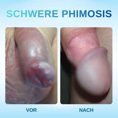 Nur noch 10 Plätze zum Sonderpreis!RZXEA™ Redundantes Präputium Korrektur Gel